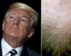 Caduta dei capelli, il farmaco usato da Trump può provocare disfunzioni sessuali e disturbi psichiatrici – .